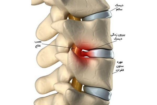 روند جراحی دیسک گردن