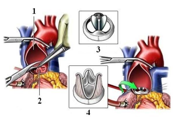 تنگی دریچه میترال